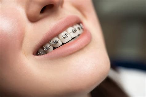 types of metal dental brackets|different types of brackets braces.